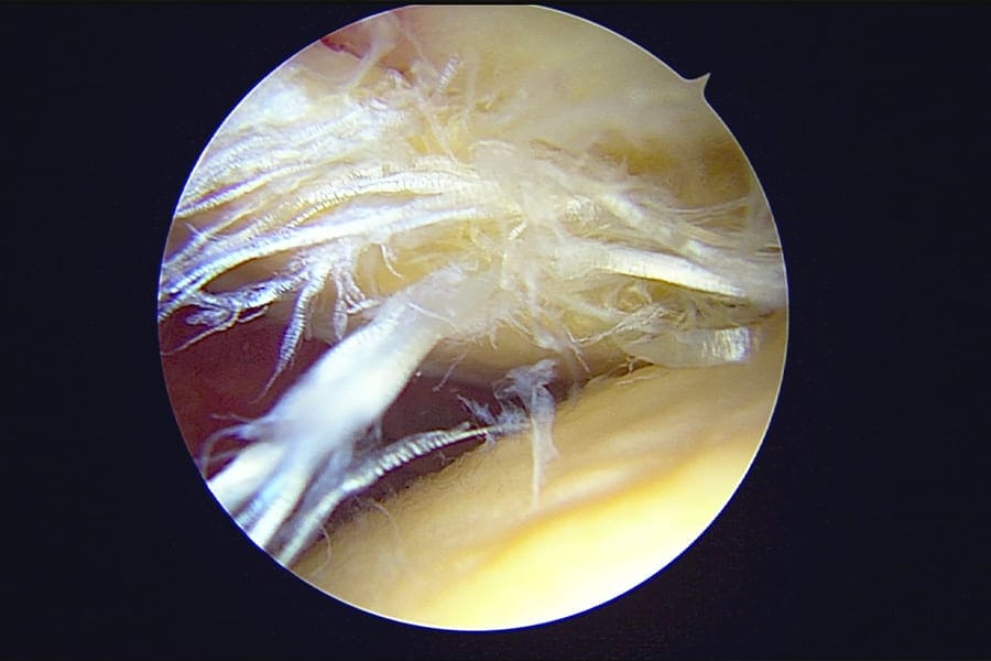 arthroscopie tendinite biceps chirurgie de l epaule chirurgien orthopediste dr ciais paris arthroscopie tendinite biceps chirurgie de l epaule chirurgien orthopediste dr ciais paris