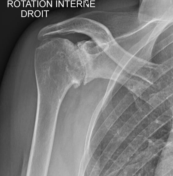 omarthrose centree epaule dr gregoire ciais chirurgien orthopediste paris