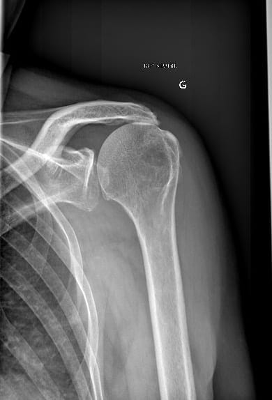 omarthrose excentree epaule dr gregoire ciais chirurgien orthopediste paris