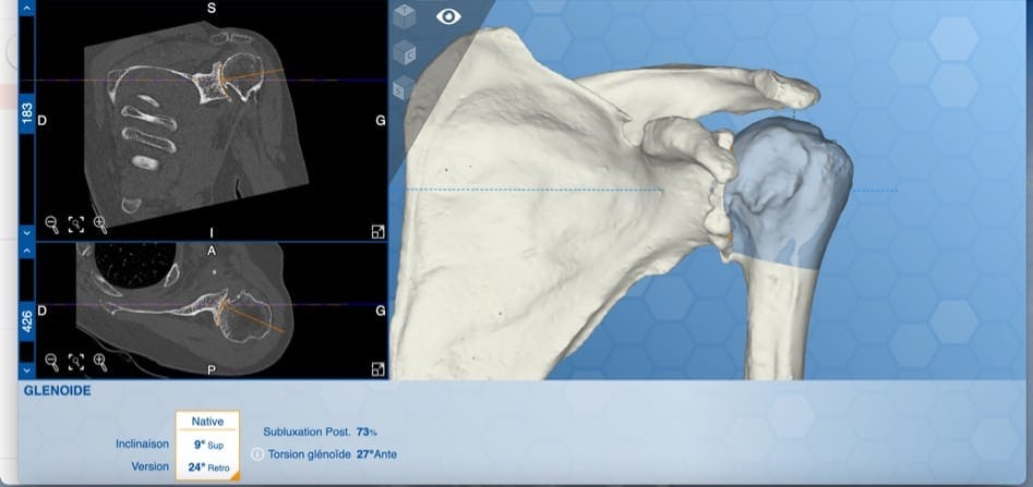 planificacion 1 dispatcher arthrose et prothese dr gregoire ciais chirurgien orthopediste paris