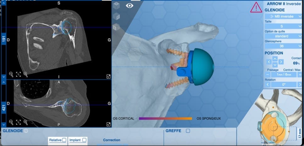 planificacion 2 dispatcher arthrose et prothese dr gregoire ciais chirurgien orthopediste paris