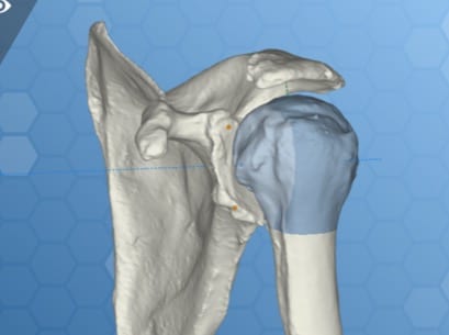 planificacion 3 dispatcher arthrose et prothese dr gregoire ciais chirurgien orthopediste paris
