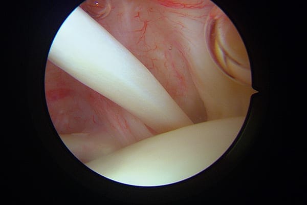 arthroscopie biceps chirurgie epaule paris docteur gregoire ciais chirurgien orthopediste arthroscopie biceps chirurgie epaule paris docteur gregoire ciais chirurgien orthopediste