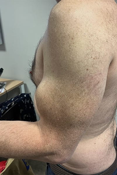 rupture du biceps popeye chirurgie epaule paris dr ciais chirurgien orthopediste rupture du biceps popeye chirurgie epaule paris dr ciais chirurgien orthopediste