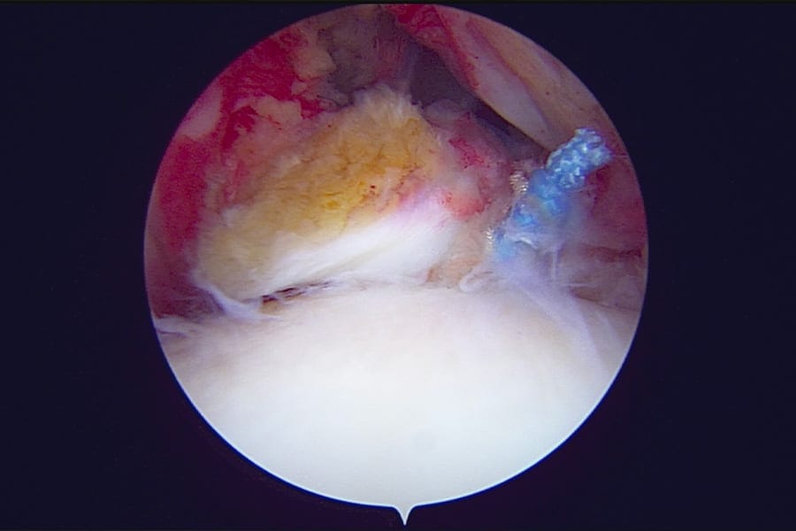 tenodese biceps reeducation chirurgie epaule paris docteur gregoire ciais chirurgien orthopediste tenodese biceps reeducation chirurgie epaule paris docteur gregoire ciais chirurgien orthopediste