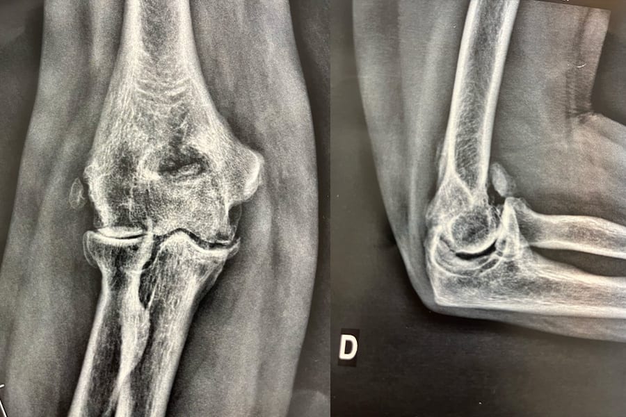 arthrose du coude traitement chirurgie coude dr gregoire ciais chirurgien orthopediste specialiste coude paris